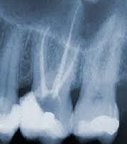 Lečenje kanala korena