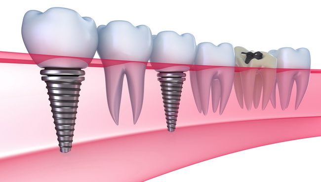 Dentist Montenegro Implantati