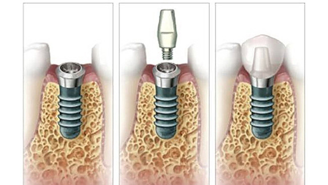 Dentist Montenegro Implantati